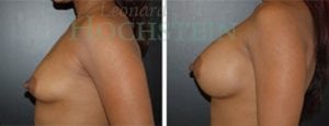 Breast Augmentation Patient