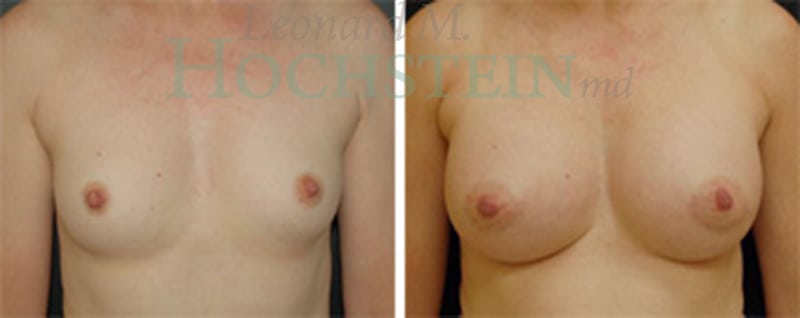Breast Augmentation Patient