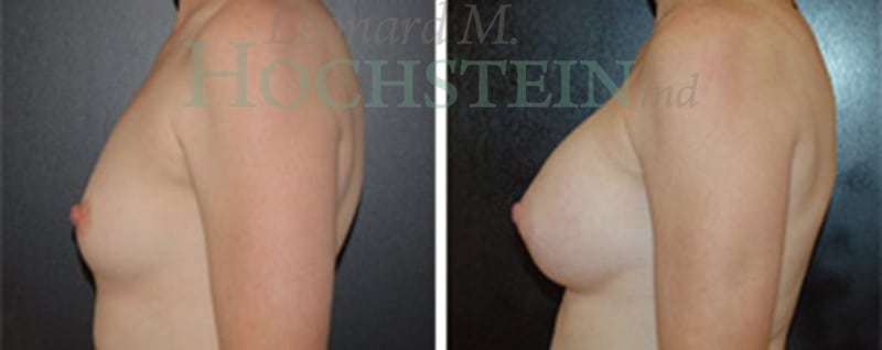Breast Augmentation Patient