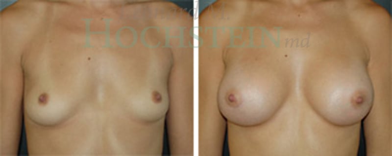 Breast Augmentation Patient