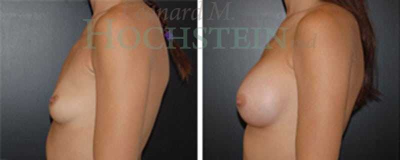 Breast Augmentation Patient