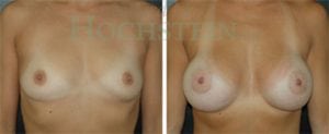 Breast Augmentation Patient