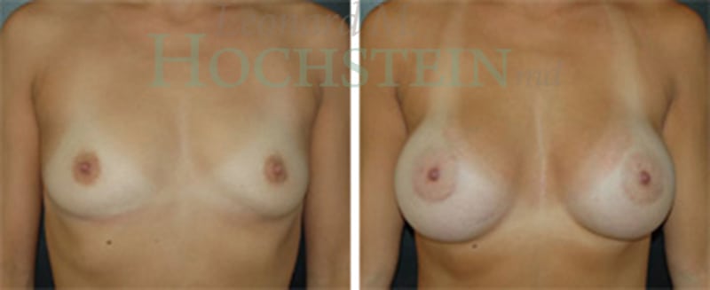 Breast Augmentation Patient