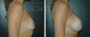 Breast Augmentation Patient