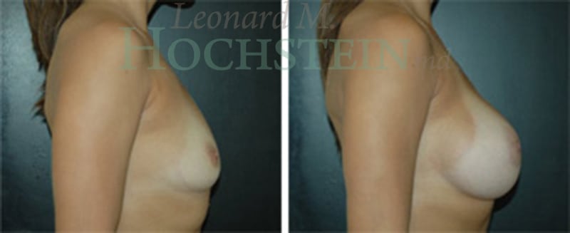 Breast Augmentation Patient
