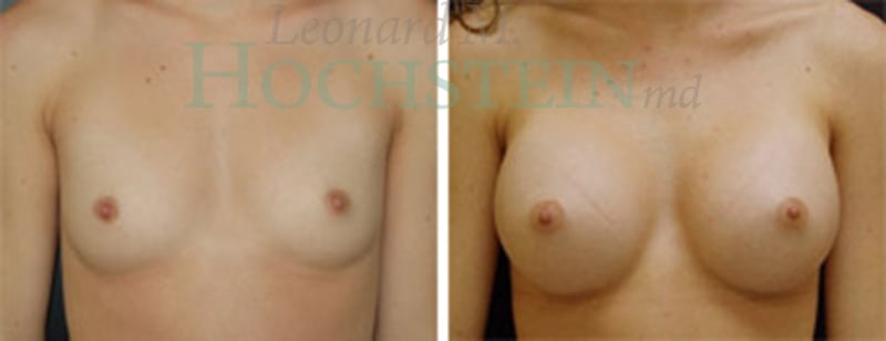 Breast Augmentation Patient