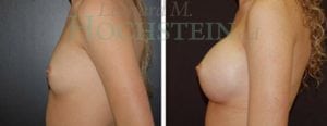 Breast Augmentation Patient