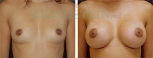 Breast Augmentation Patient