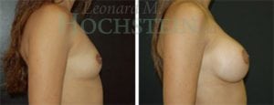 Breast Augmentation Patient