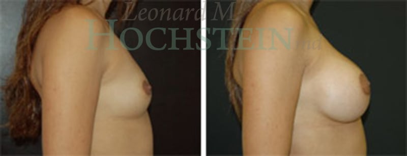 Breast Augmentation Patient
