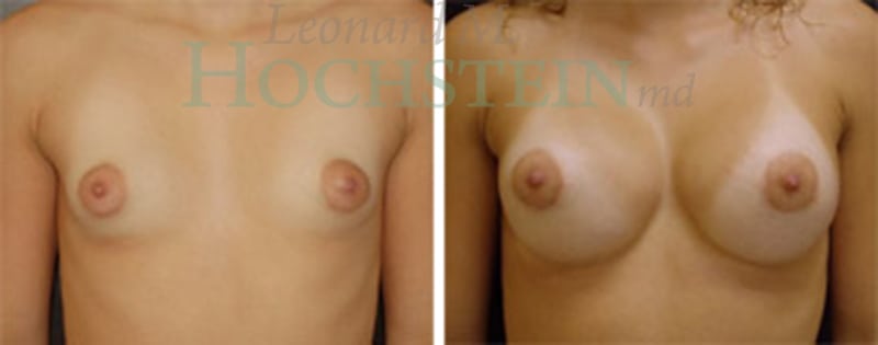 Breast Augmentation Patient