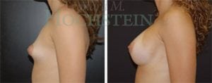 Breast Augmentation Patient