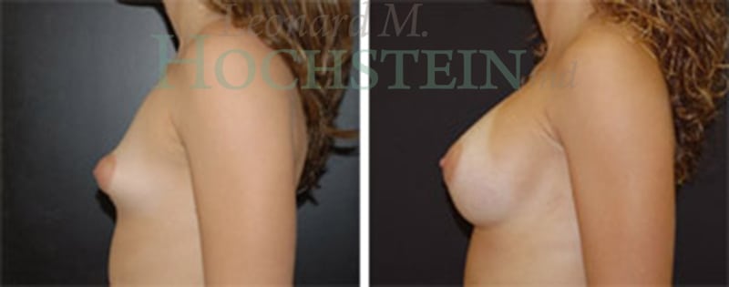 Breast Augmentation Patient