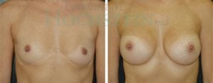 Breast Augmentation Patient