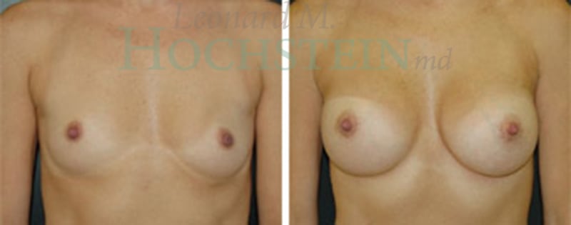 Breast Augmentation Patient