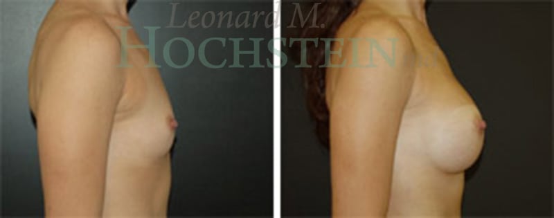 Breast Augmentation Patient