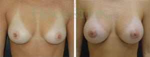 Breast Augmentation Patient