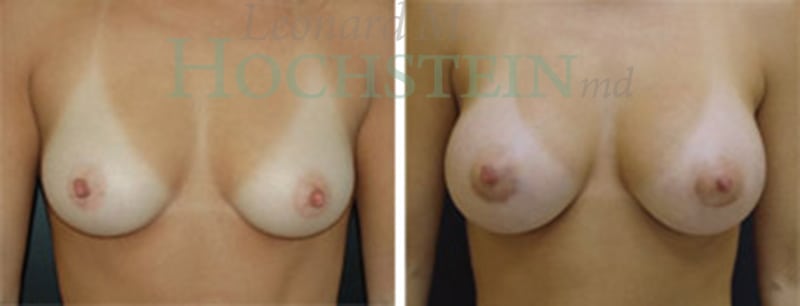 Breast Augmentation Patient
