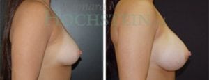 Breast Augmentation Patient