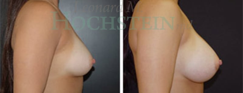 Breast Augmentation Patient