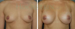Breast Augmentation Patient