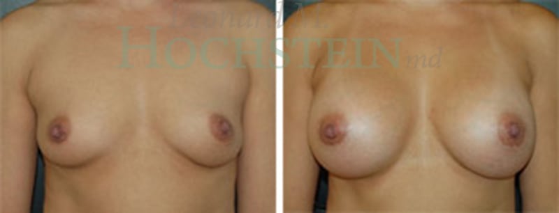 Breast Augmentation Patient