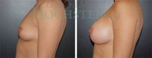 Breast Augmentation Patient