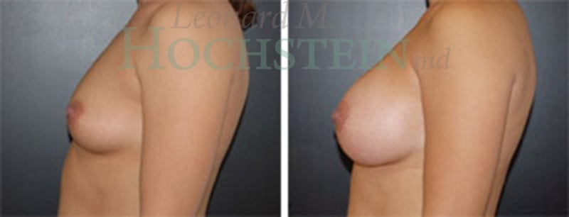 Breast Augmentation Patient