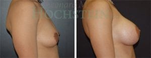 Breast Augmentation Patient