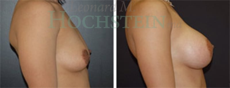 Breast Augmentation Patient