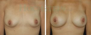 Breast Augmentation Patient