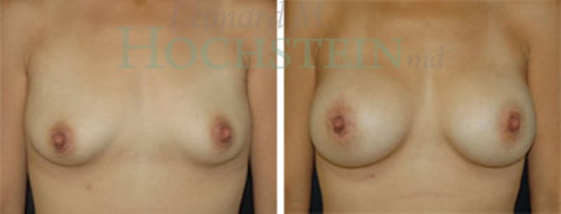 Breast Augmentation Patient