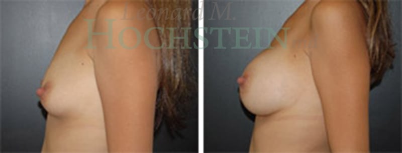 Breast Augmentation Patient