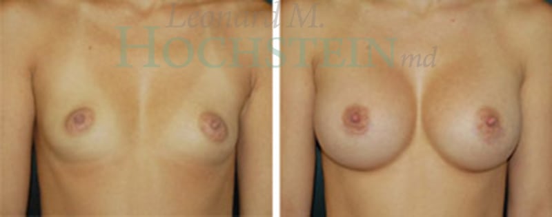 Breast Augmentation Patient