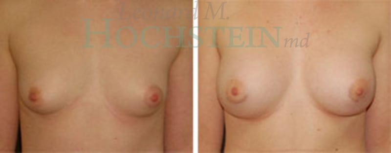 Breast Augmentation Patient
