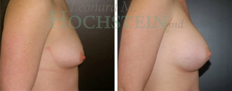 Breast Augmentation Patient