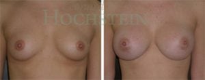 Breast Augmentation Patient