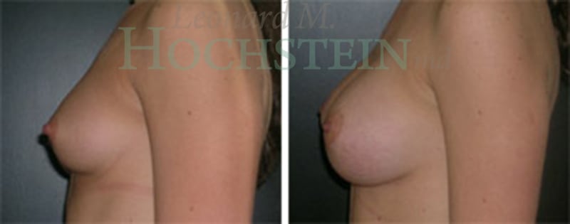 Breast Augmentation Patient