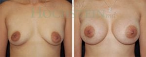 Breast Augmentation Patient