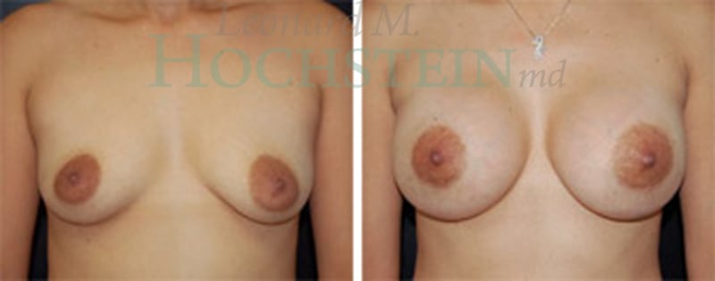 Breast Augmentation Patient