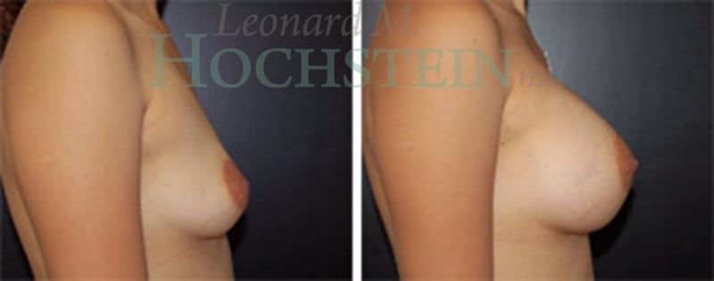 Breast Augmentation Patient