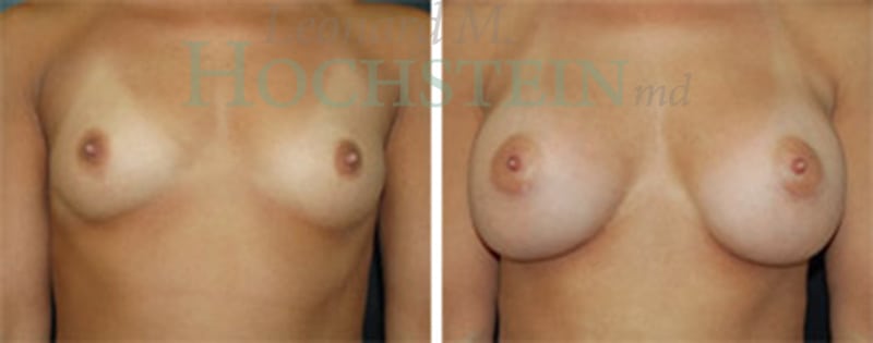 Breast Augmentation Patient