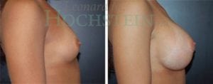 Breast Augmentation Patient