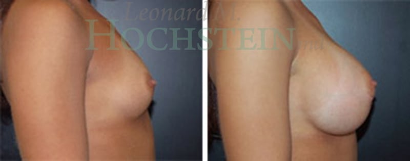 Breast Augmentation Patient
