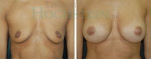 Breast Augmentation Patient