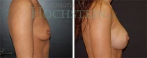 Breast Augmentation Patient