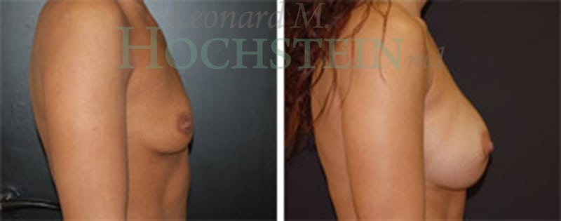 Breast Augmentation Patient