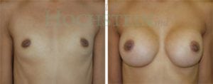 Breast Augmentation Patient