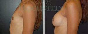Breast Augmentation Patient