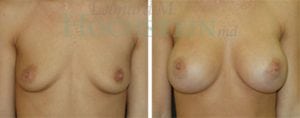 Breast Augmentation Patient